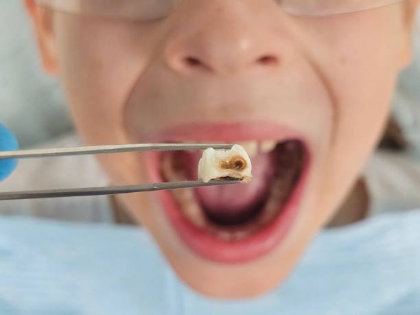 Best Emergency Broken Tooth Repair in Port Clinton, OH