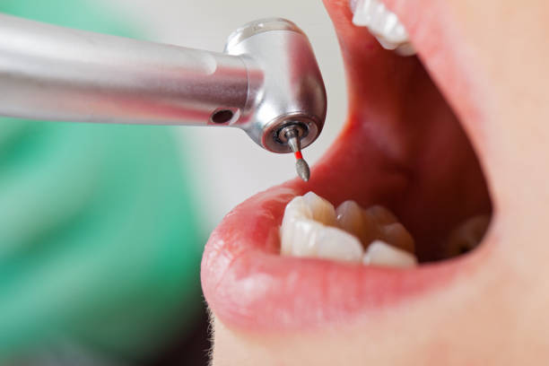 Best Emergency Wisdom Teeth Removal in Port Clinton, OH